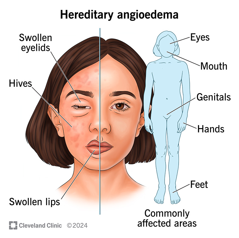 HAE Symptoms: Recognizing Life-Threatening Swellings